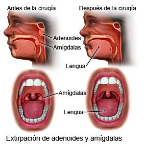 Cirugía de amígdalas