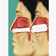 Tapón nasal para sangrado nasal (Merocel)