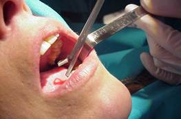 Toma de biopsias en consulta