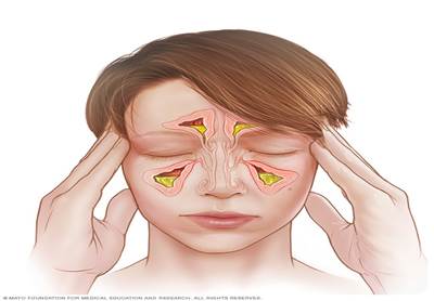 complicaciones de la sinusitis