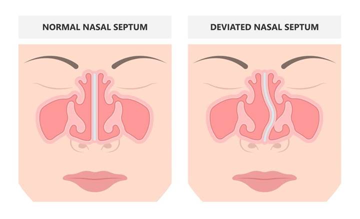 desviación del tabique nasal