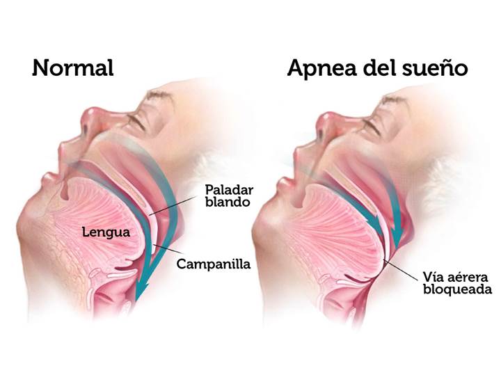 apnea del sueño
