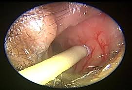 Cauterización para sangrado nasal (nitrato de plata)