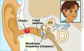extracción de cuerpo extraño en oído y nariz en niños